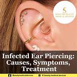 Claire's Ear Piercing Infection: Causes, Symptoms, and Treatment