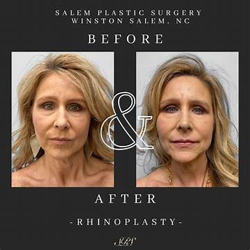 Cosmetic Surgery Revelations in Winston-Salem