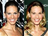 Hilary Swank Plastic Surgery Before and After