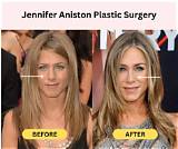 Jennifer Aniston Have Plastic Surgery