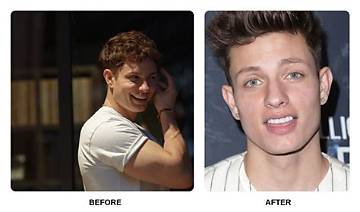Matt Rife Before Dental
