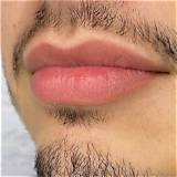 Remarkable Lip Enhancement: Explore Men's Lip Fillers Before and After