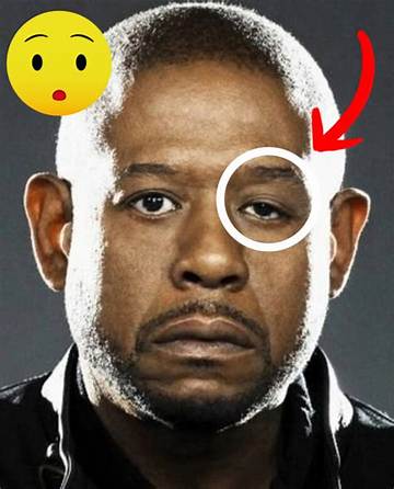 Unveiling Forest Whitaker's Eye Problem: Unraveling the Mystery